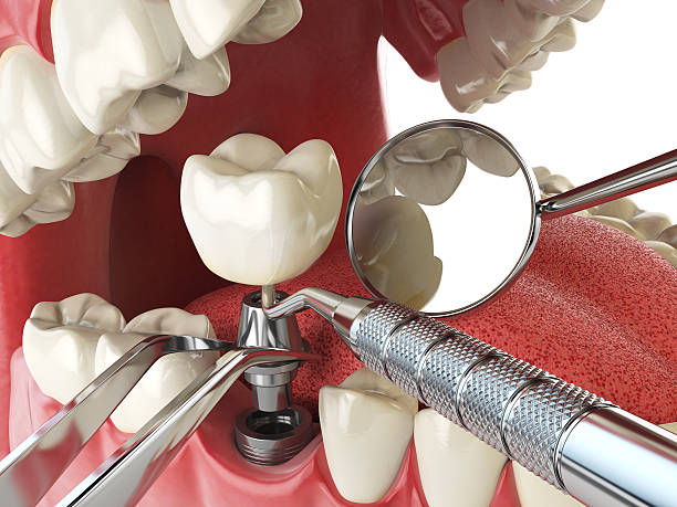 Best Dentist for Tooth Abscess  in North Charleston, SC